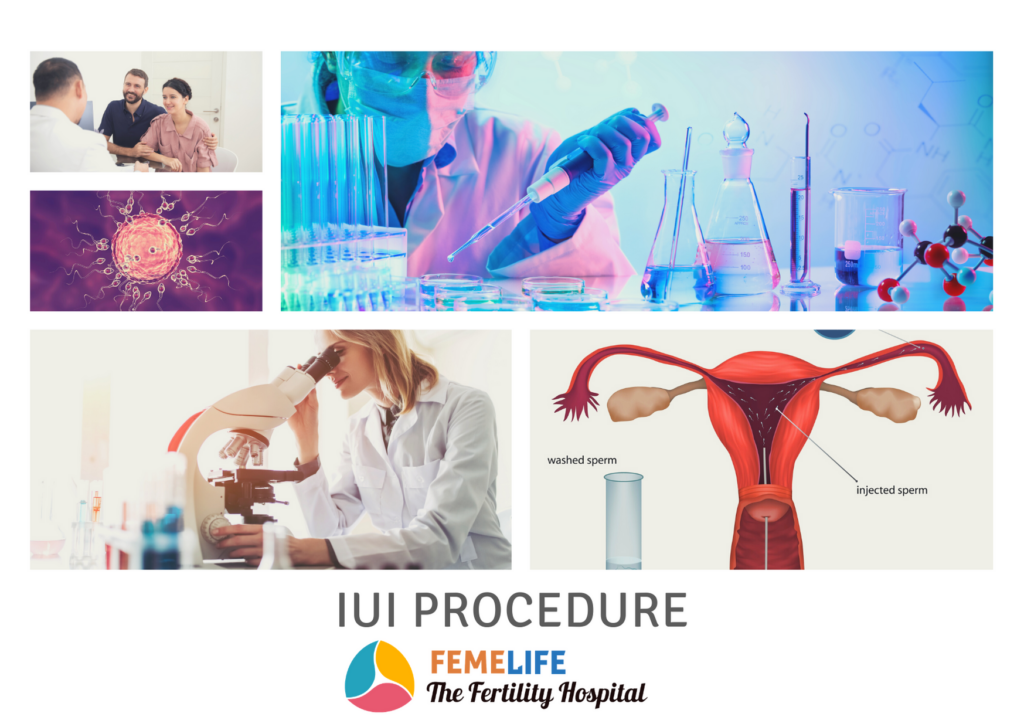 IUI Procedure : Intrauterine Insemination | FEMELIFE